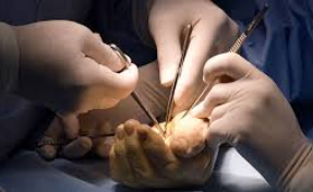 Free tissue transfer procedures