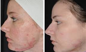 Scar revision and skin grafting
