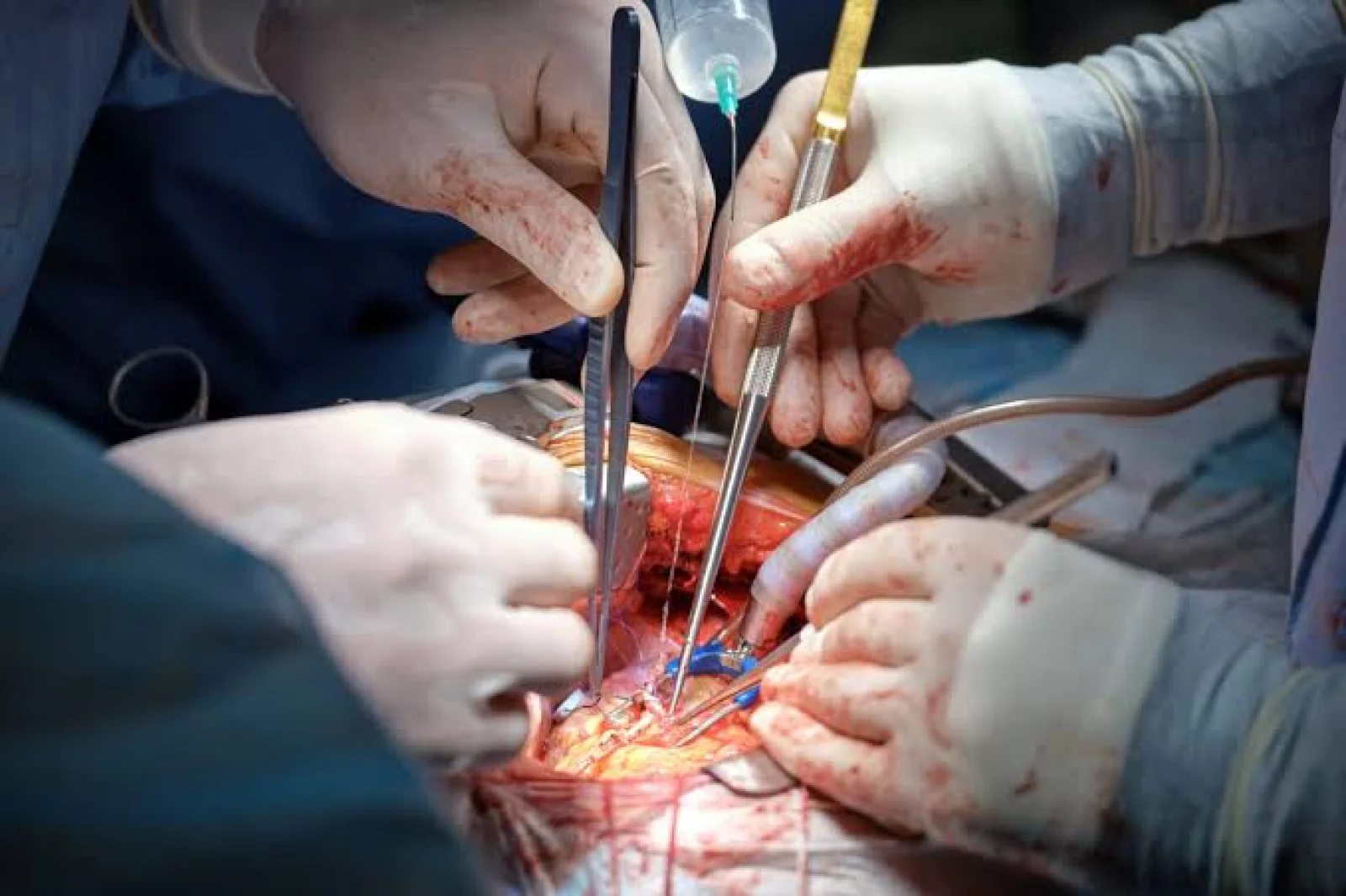 Abdominal Aortic Aneurysm Repair (Open / Endovascular) Banner