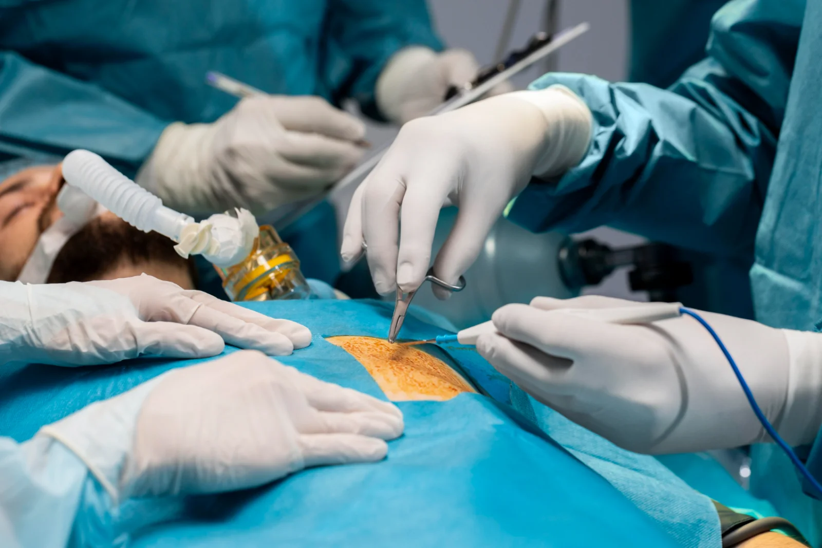 Colostomy / Ileostomy Creation & Closure Banner