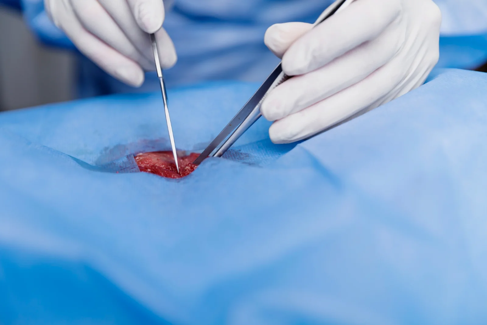 Endovascular Stent Grafts & Catheters Banner