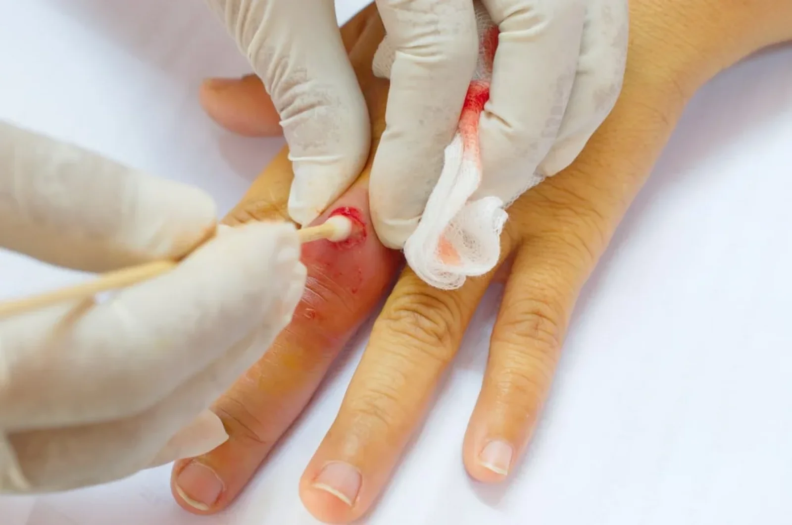 Abscess Incision & Drainage Banner